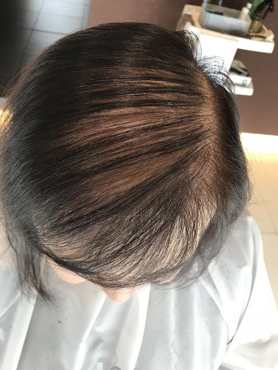 PRP Hair Treatment: A New Era in Hair Care