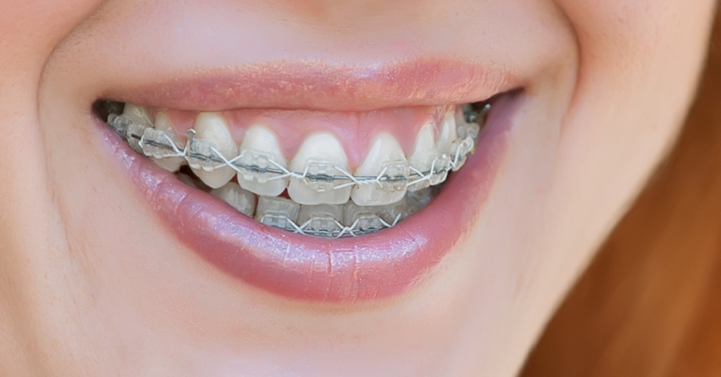 Metal Braces in Dubai: Quality Treatment Awaits You