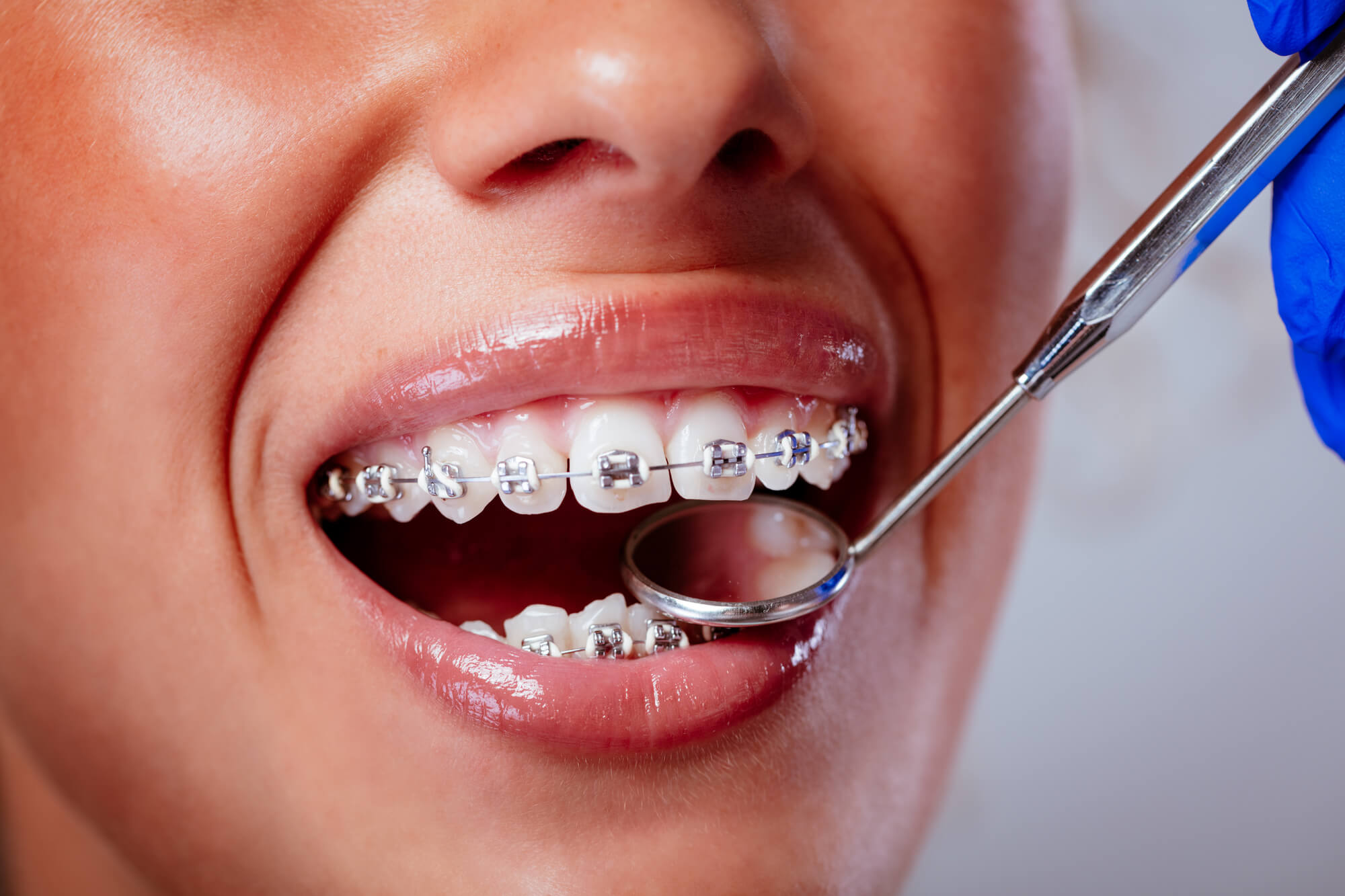 Metal Braces in Dubai: Straightening Teeth with Style