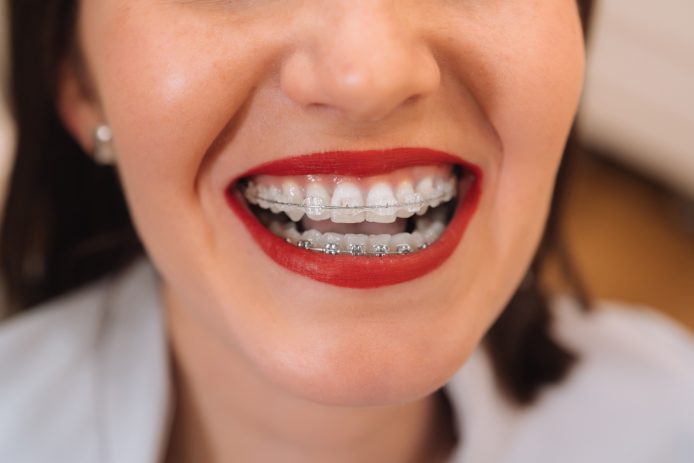 Experience the Best Metal Braces  Today