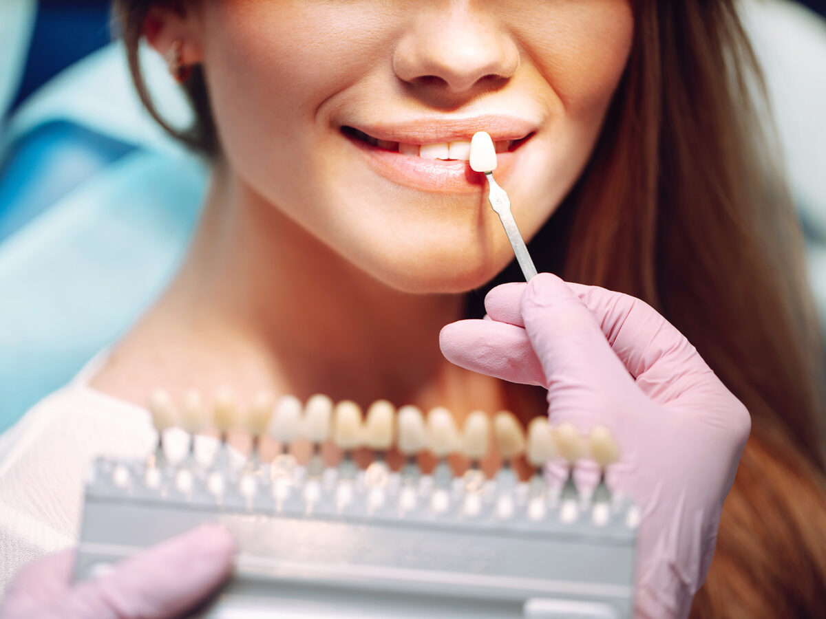 Dubai’s Best Composite Veneers Cost: Top Clinics