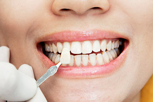 Cost-Effective Options for Composite Veneers in Dubai