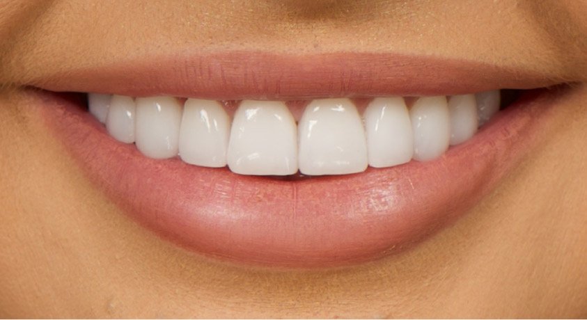 Your Comprehensive Composite Veneers Cost Dubai Overview