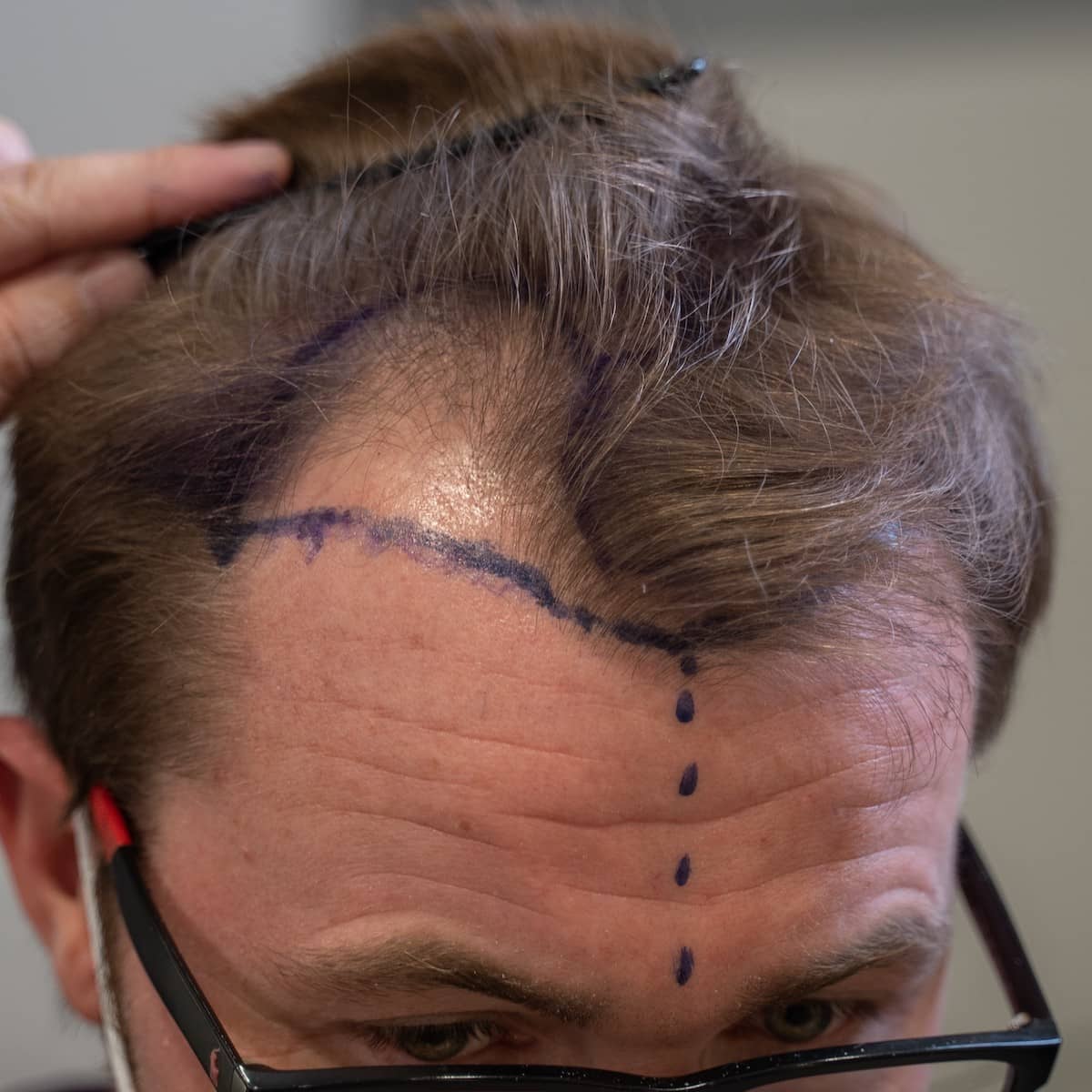 Hair Transplant Cost in Dubai: Top 10 Treatmant