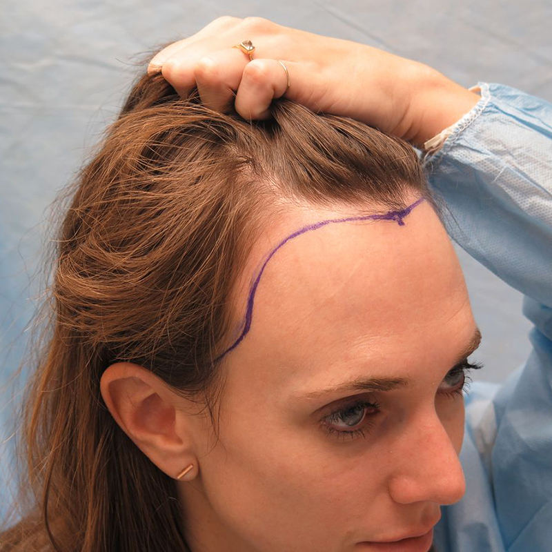 Hair Transplant Cost: Expert Insights