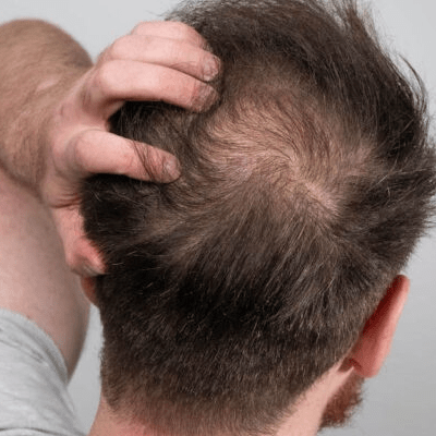 Consult for Scalp Micropigmentation in Dubai