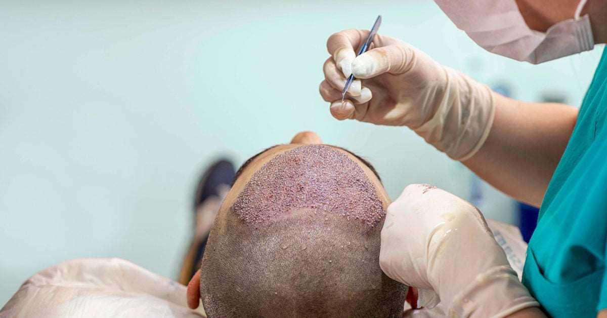 Is Hair Transplant Cost: Myths vs. Reality Explained