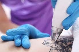 The Ultimate Solution: Laser Tattoo Removal Explained