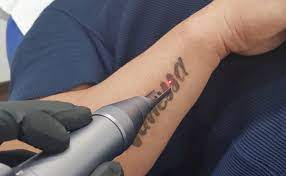 Uncover the Secrets of Laser Tattoo Removal