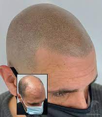 Scalp Micropigmentation: Dubai Dermatologists' Insights