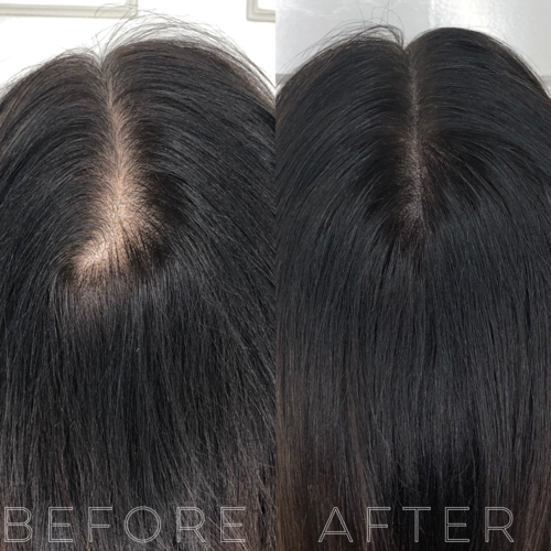 Hair Replacement Treatments Tailored for Dubai