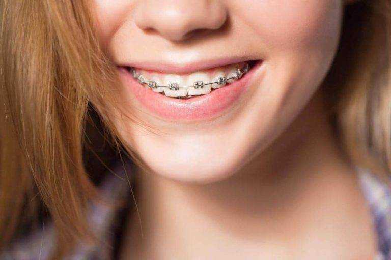 Metal Braces in Dubai: The Key to Oral Health