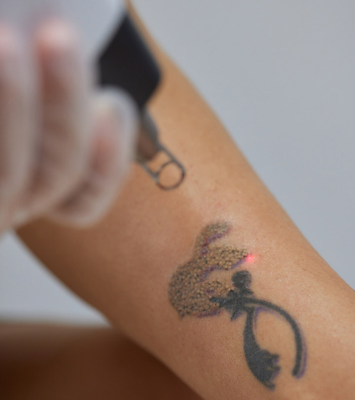 Top Benefits of Laser Tattoo Removal You Should Know