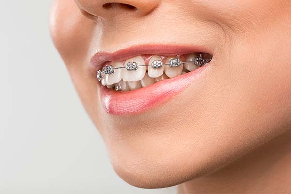 Embrace Change with Stylish Metal Braces