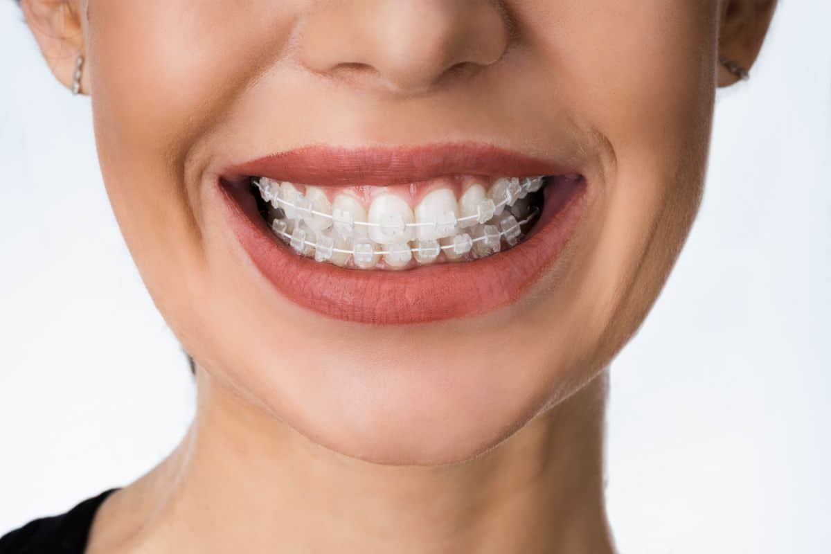 Metal Braces: The Affordable Solution for Straight Teeth