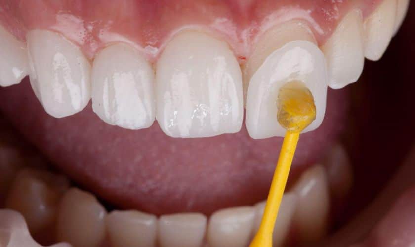 Dental Veneers: Smile Brighter, Live Better