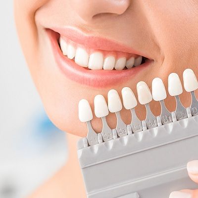 Composite Veneers Cost in Dubai: 2024 Price Update