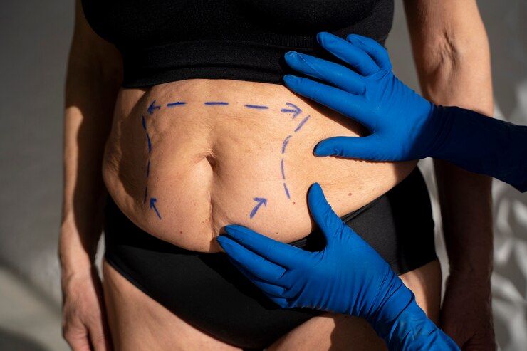 Laser Liposuction : The Future of Body Shaping