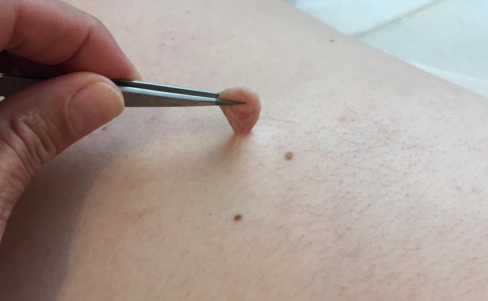 How to Remove Skin Tags on Inner Thigh: Myths Debunked