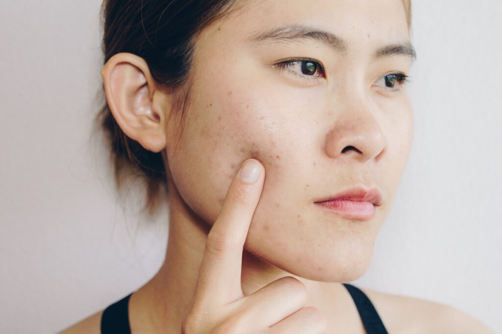 Laser Acne Treatment: Fast, Safe, and Effective